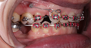 3次元的に歯を動かす治療